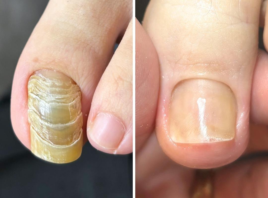 新浦安駅徒歩6分_手足のトラブル専門サロンaccorto_爪甲湾症の症例